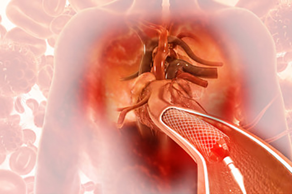 Angioplasty with stent illustration