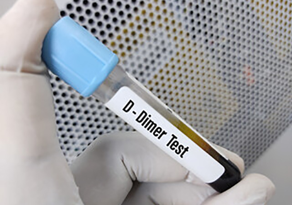 D-dimer test